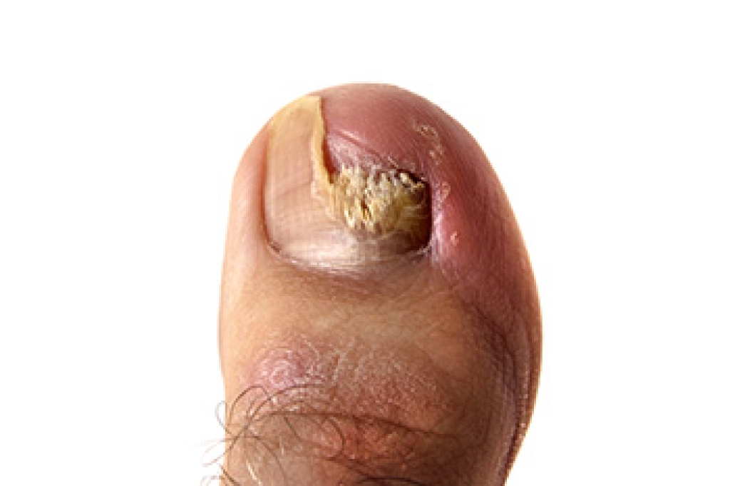 Changes in Toenail Health