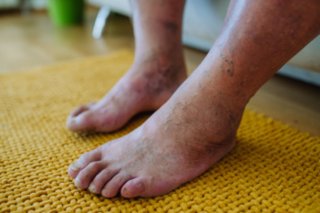 Protecting Foot Health With Diabetic Foot Care