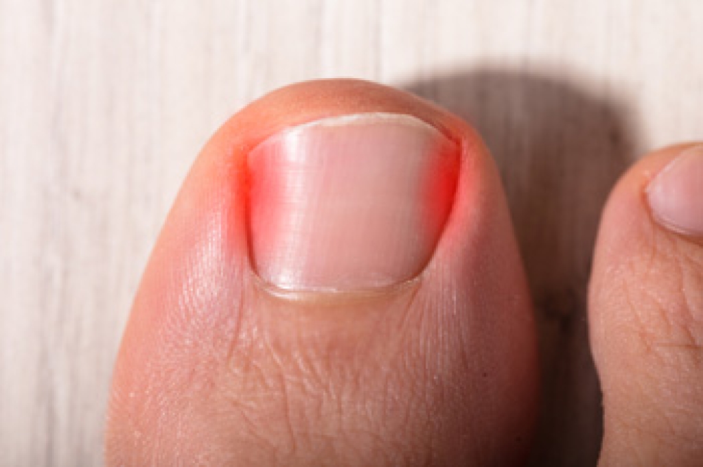 Toenails That Grow Into the Skin