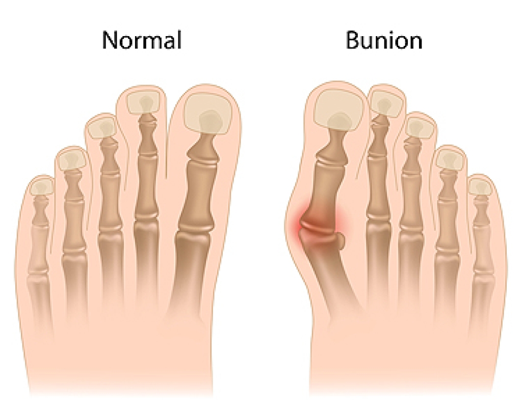 How Aging and Lifestyle Factors Contribute to Bunion Development