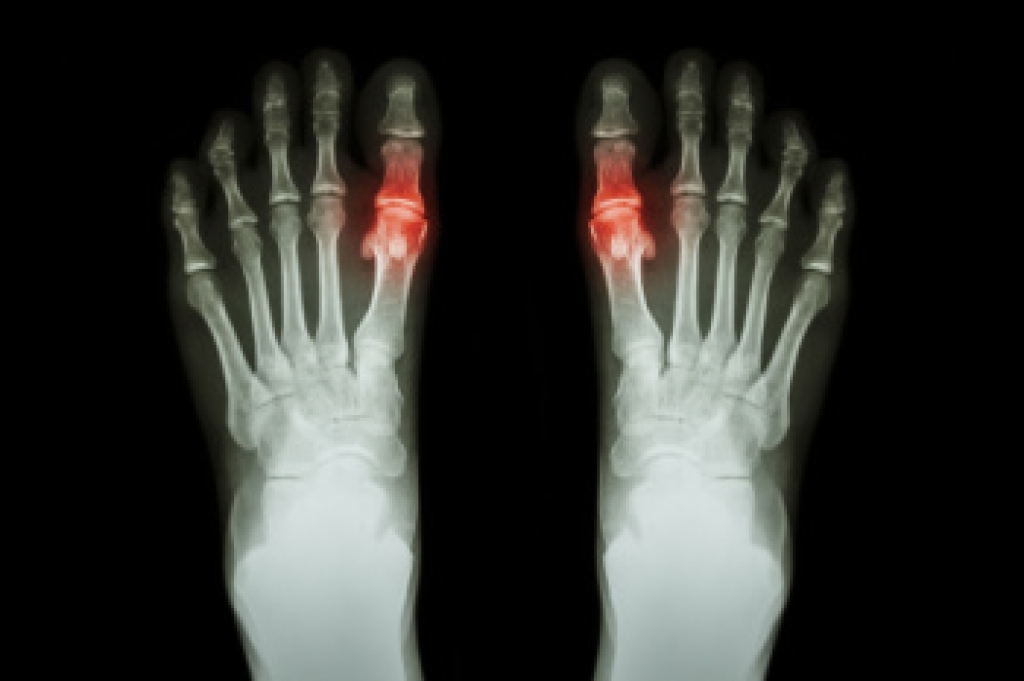 Why Gout Often Targets the Big Toe