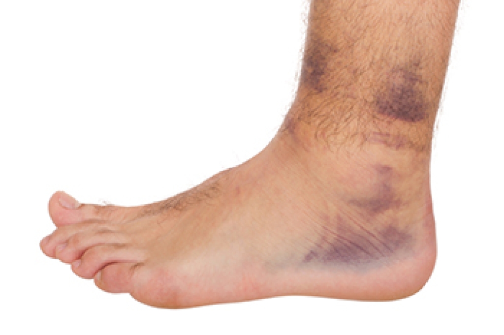 Common Causes and Types of Ankle Sprains