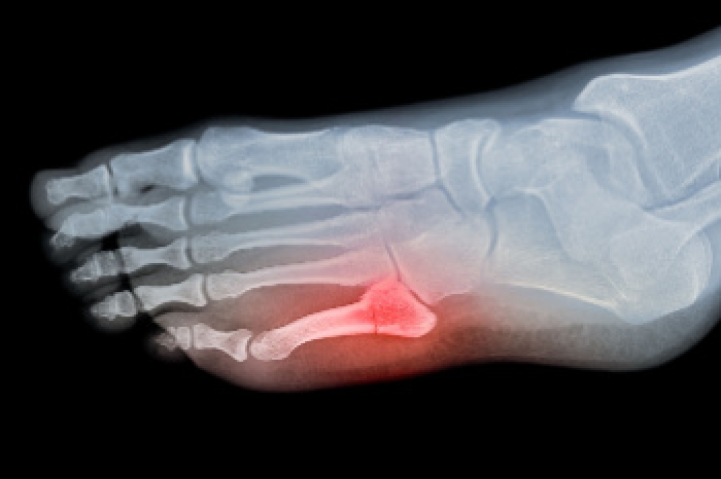 Metatarsal Foot Fractures and Common Causes of Forefoot Injury