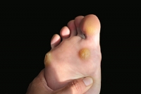 How Warts Are Formed and Treated