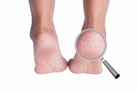 Is There a Link Between Vitamin B-3 Deficiency and Cracked Heels?