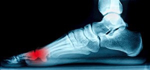 Identifying Sesamoiditis