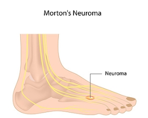 Do I Have Morton&#039;s Neuroma?